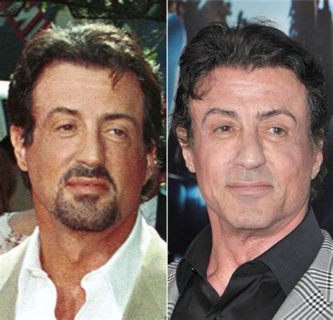 Sylvester Stallone Plastic Surgery Before And After