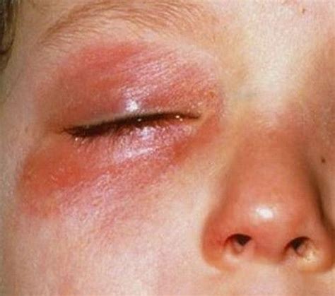 A Severe Form Of Rashes Under The Eyesimage Dry Skin Around Eyes