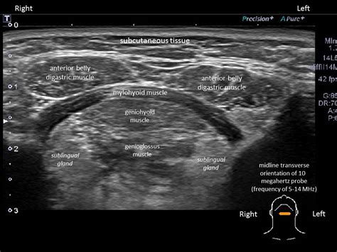 Parotid Gland Swelling Ultrasound