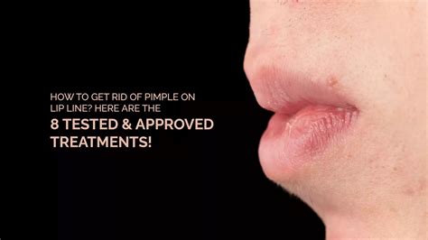 How To Get Rid Of Pimple On Lip Line Here Are The 8 Tested And Approved