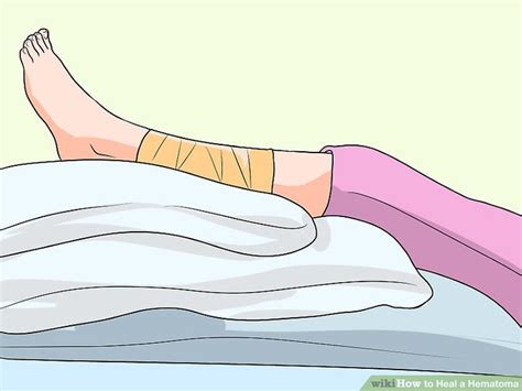 How To Heal A Hematoma 10 Steps With Pictures Wikihow