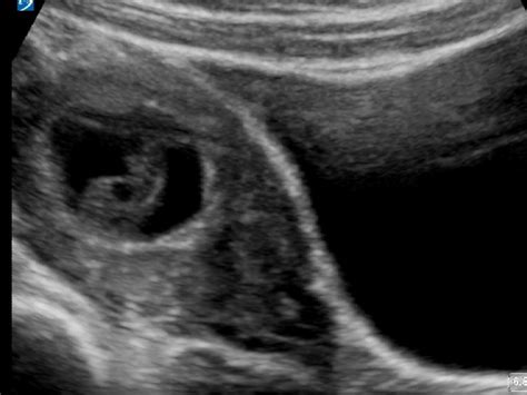 Miscarriage Archives Critical Care Sonography