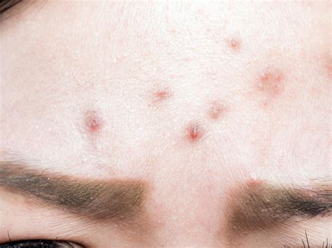 Small Bumps On Forehead Forehead Acne Cause Small Bumps On Face My