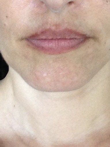 Discolored Skin Around Lips