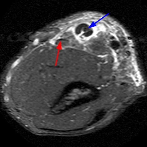 Distal Biceps Tendon Rupture Elbow Radsource