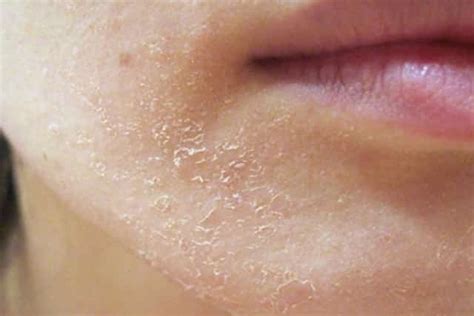 Dry Patches On Face Flaky Peeling Red White Pictures