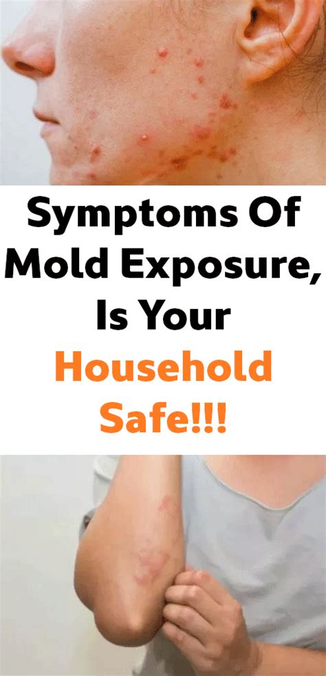 Symptoms Of Mold Exposure Is Your Household Safe Mold Exposure