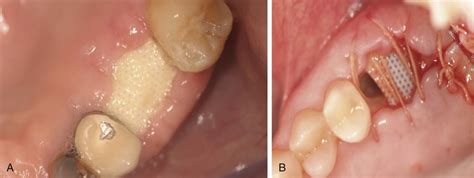 Bone Grafting Complications Pocket Dentistry