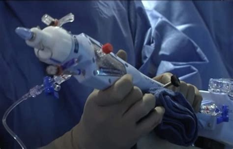 Transcatheter Mitral Valve Repair Mitral Valve Repair Surgery Using