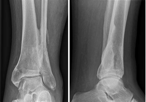 Incidence And Clinical Relevance Of Tibiofibular Synostosis In