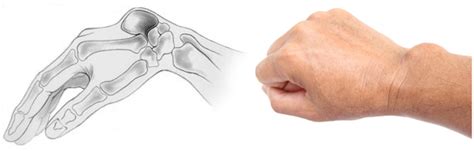 Ganglion Cyst Synovial Cyst Wrist Conditions Orthopedics