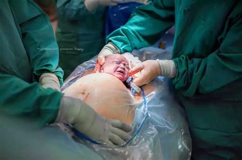 Why Are C Sections Performed Reasons Proguide