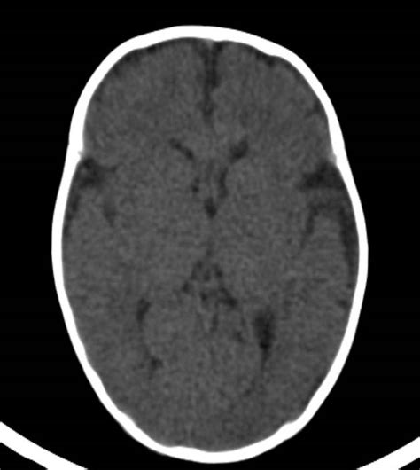 Normal Brain Ct 2 Month Old Image