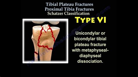 Comminuted Tibial Plateau Fracture