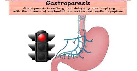 Gastroparesis Delayed Gastric Emptying