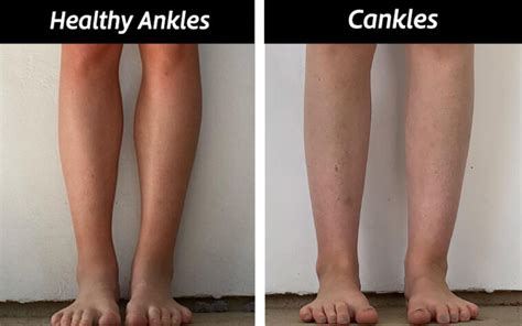 Causes And How To Get Rid Of Cankles With Exercise And Surgery