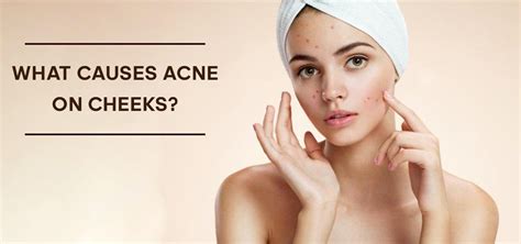 What Causes Acne On Cheeks Symptoms And Easy Prevention Tips