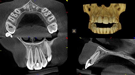 Cone Beam Ct 3d Scan — Fidi Endodontics Nyc Endodontists And Manhattan