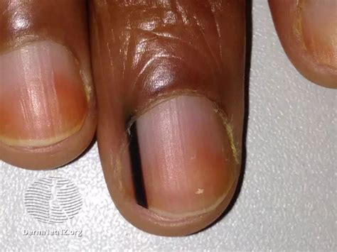 5 Ways To Take Care Of Fingernails Affected By Lupus Mylupusteam