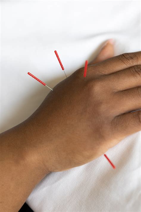 Local And Distal Acupuncture Resilient Health Acupuncture