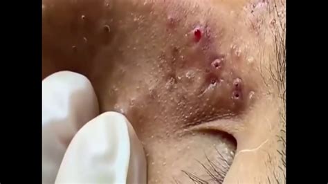 Blackheads On Nose And Forehead Best Pimple Popping Part1