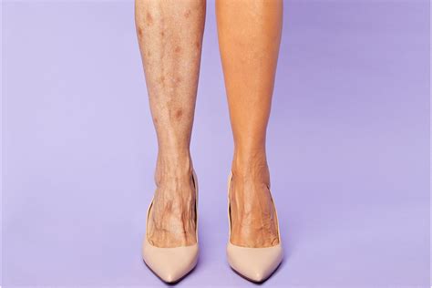 Tarte Just Launched A Body Concealer That Covers Unwanted Veins In