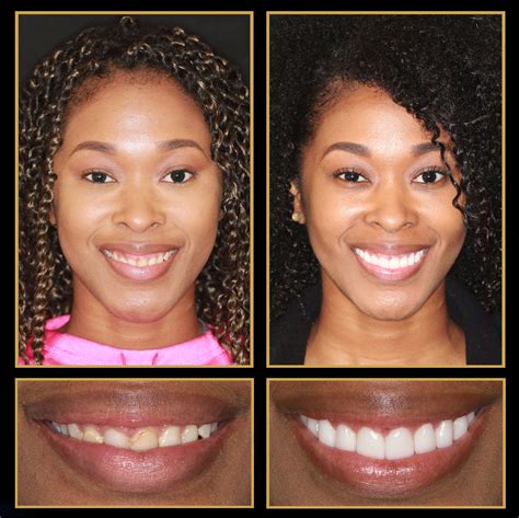 Pin On Amazing Smile Makeovers