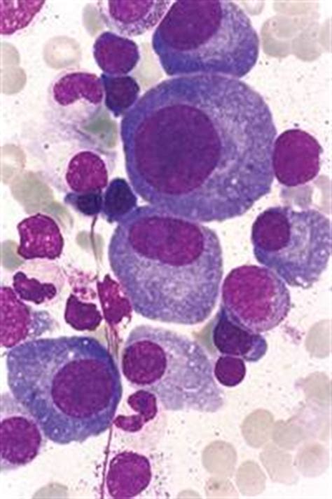 Anemia in a patient previously treated for renal ...