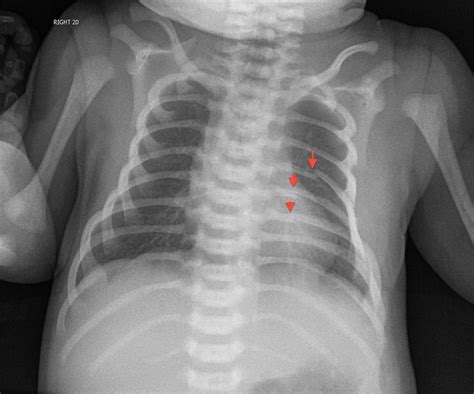Unforeseen Rib Fracture Findings In Infant Chest Radiographs Evidence