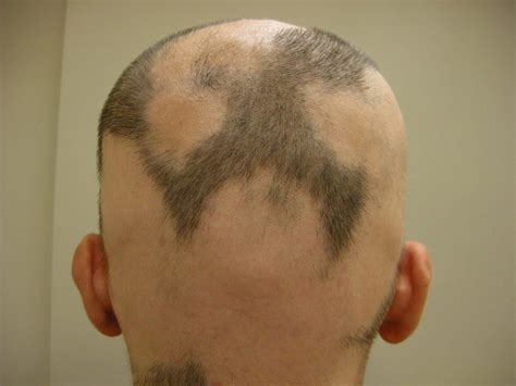 Alopecia Areata Sintomi Cause E Cure Init On Line