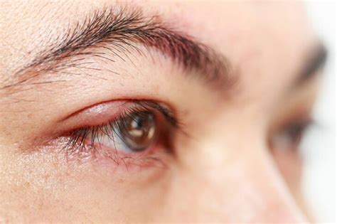 Zapalenie Nerwu Wzrokowego Objawy I Leczenie Ile Trwa