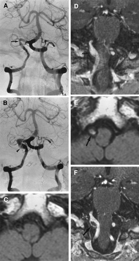 Clinical And Neuroradiological Features Of Intracranial Vertebrobasilar Artery Dissection Stroke
