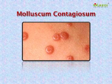 PPT Molluscum Contagiosum Symptoms Causes Diagnosis Treatment And Prevention