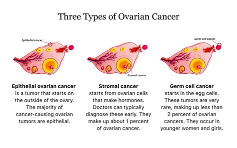 Symptoms of ovarian cancer may include bloating and weight gain, pain during intercourse, or a change in bowel habits. Ovarian Cancer Health Guide | Symptoms, Types & Treatment