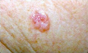 Squamous cell carcinomas could also manifest as sores that won't heal (as mentioned previously); BBC News | HEALTH | Cancer tackled by wart cream