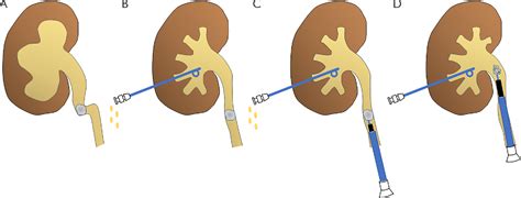 Figure 1 From The Impact Of Preoperative Percutaneous Nephrostomy As A