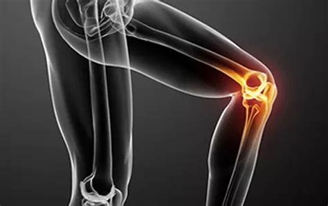 Is Arthroscopic Surgery Effective For Arthritic Knees Lawrence Park