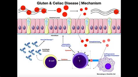 Gluten Mechanisms Of Celiac Disease And Gluten Sensitivity Youtube