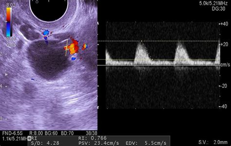 Sonogram Of A Follicular Cyst With Doppler Ultrasonography Download