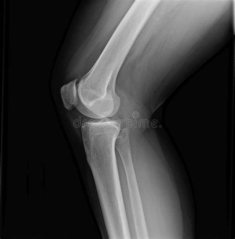 Right Knee Joint X Ray Of Mature Female With Osteoarthritis Stock Photo