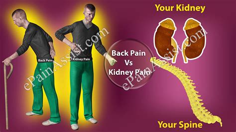 Back Pain Vs Kidney Pain Differences Worth Knowing