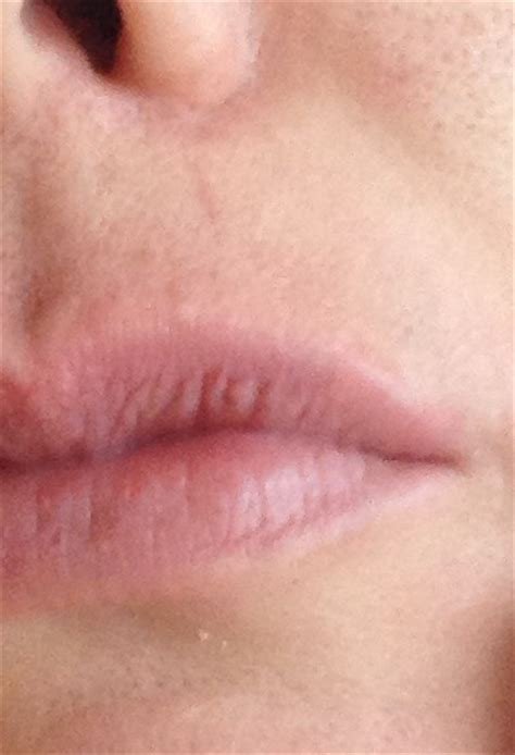 Hi Yesterday I Found A Lump Inside My Upper Lip Its Small