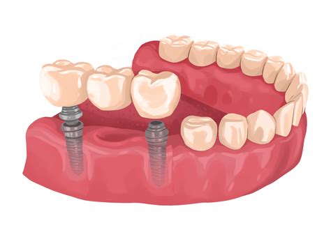 However, others can cap at a certain number, regardless of the cost of. What are the types of dental bridges you can get? - G4 by Golpa