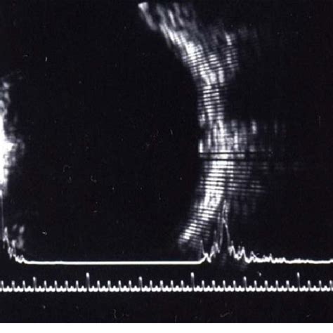 Ultrasound A Scan Showing A Single High Spike Around 5 Oclock