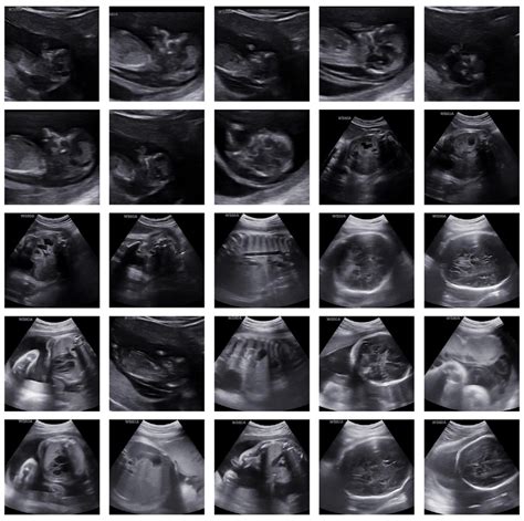 Some Examples Of Fetus Ultrasound Data Set Images Used For Experiments