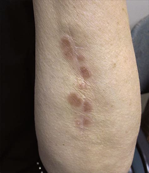 Tender Papules And Plaques Adjacent To A Scar—quiz Case Dermatology