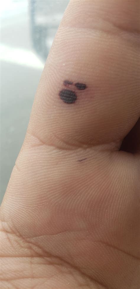 This Blood Blister On My Hand Looks Like A Little Face Yelling In Anger