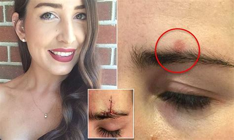 How A Melbourne Womans Pimple Turned Out To Be Skin Cancer Daily