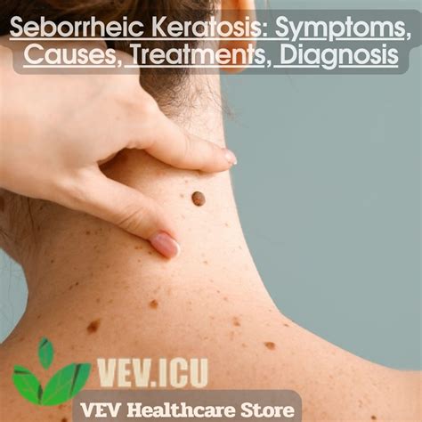 Seborrheic Keratosis Symptoms Causes Treatments Diagnosis