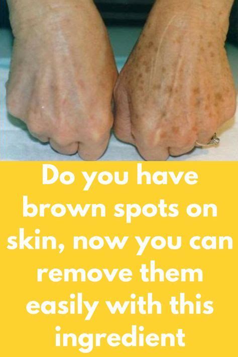 Do You Have Brown Spots On Skin Now You Can Remove Them Easily With